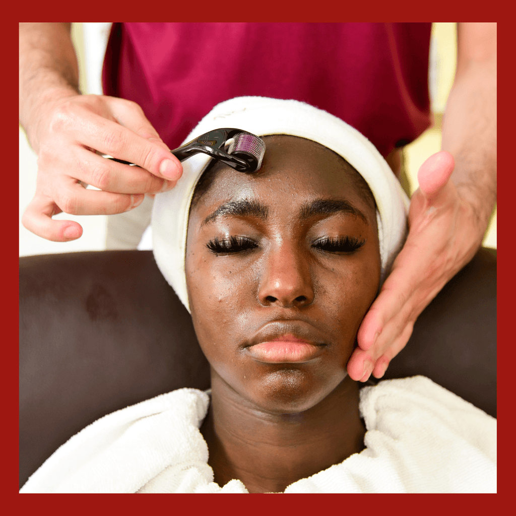 FACIAL SKIN NEEDLING ( with combination of PEELS )-0